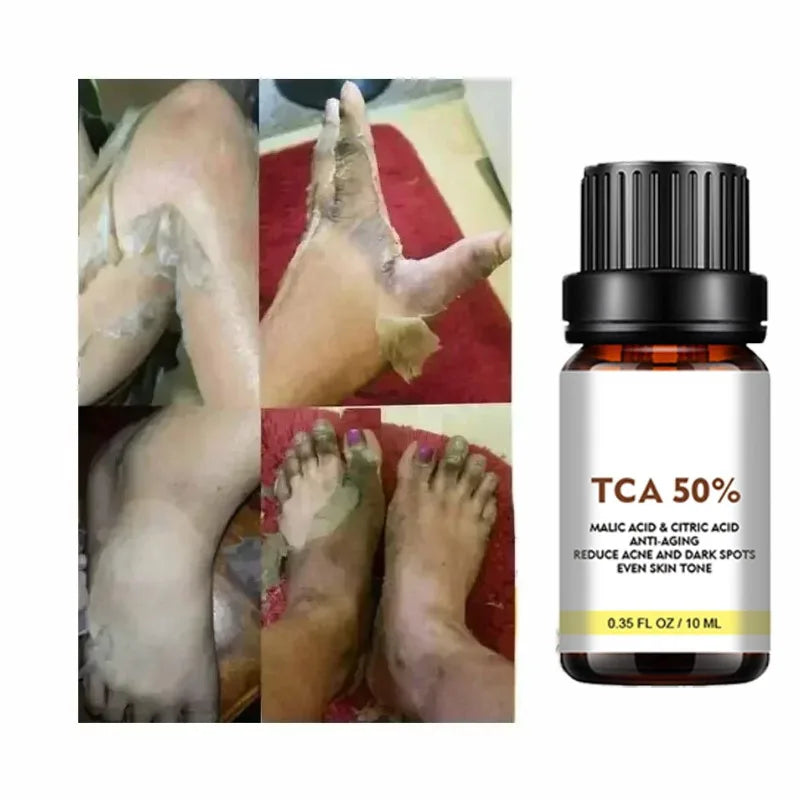 Acid Peeling Serum Chemical Exfoliant Peel for remove Face Dark Skin Spots Whiten Lighten Melanin Peeling Solution Skin Peel