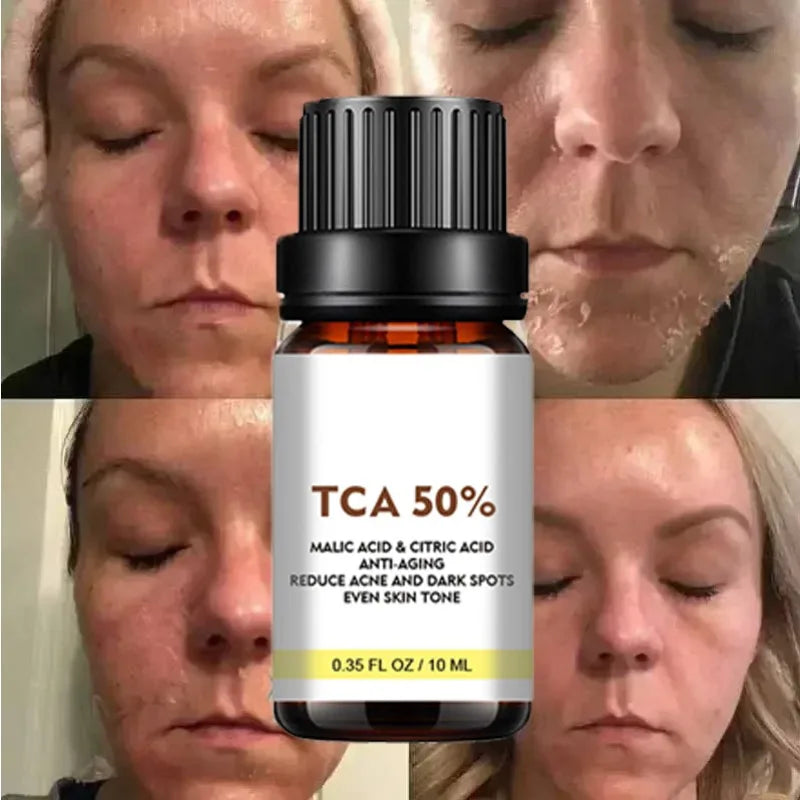 Acid Peeling Serum Chemical Exfoliant Peel for remove Face Dark Skin Spots Whiten Lighten Melanin Peeling Solution Skin Peel