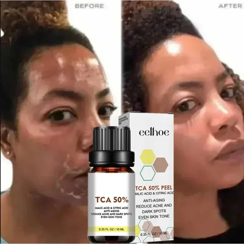 Acid Peeling Serum Chemical Exfoliant Peel for remove Face Dark Skin Spots Whiten Lighten Melanin Peeling Solution Skin Peel